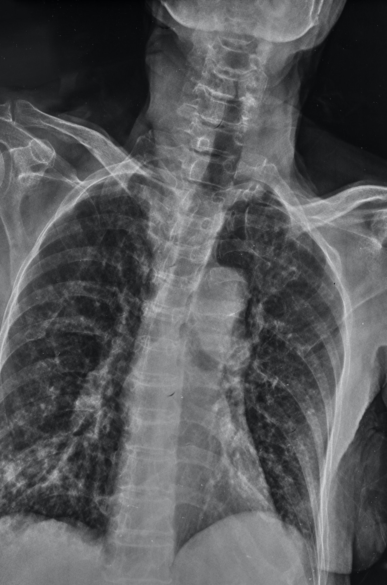 x-rays