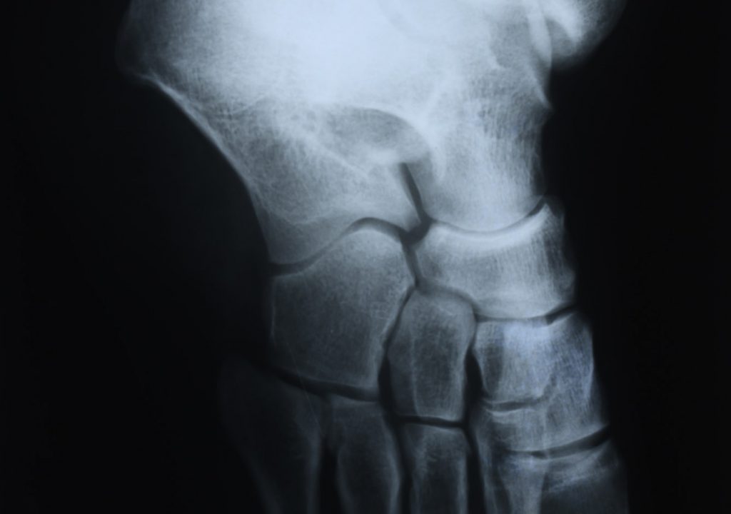 Anble X-ray detail