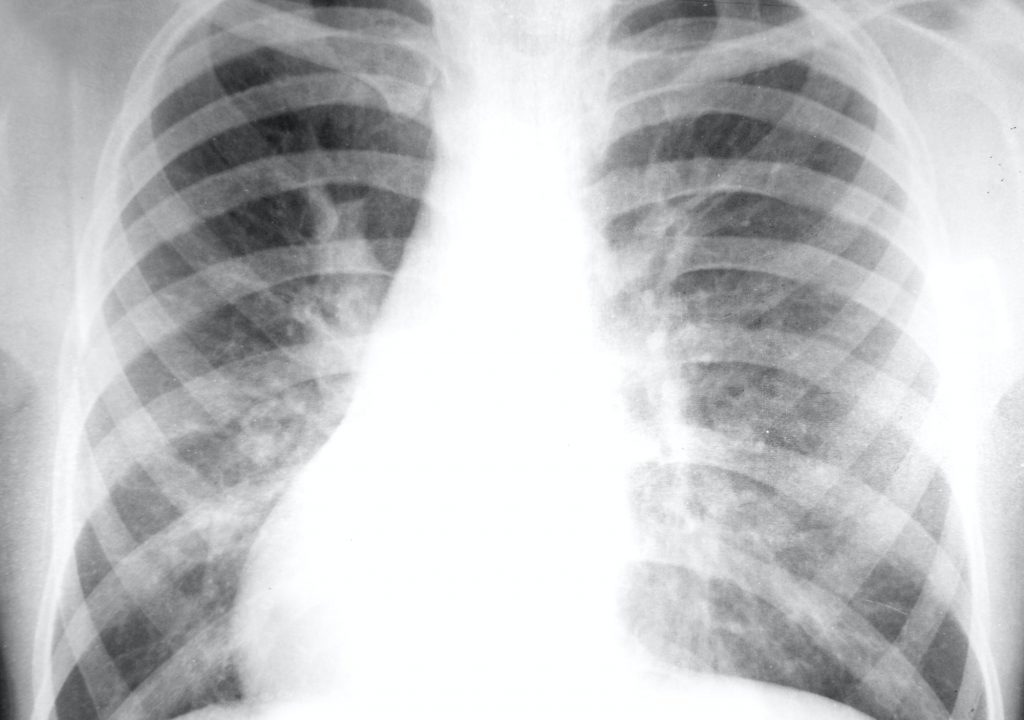 Chest X-ray