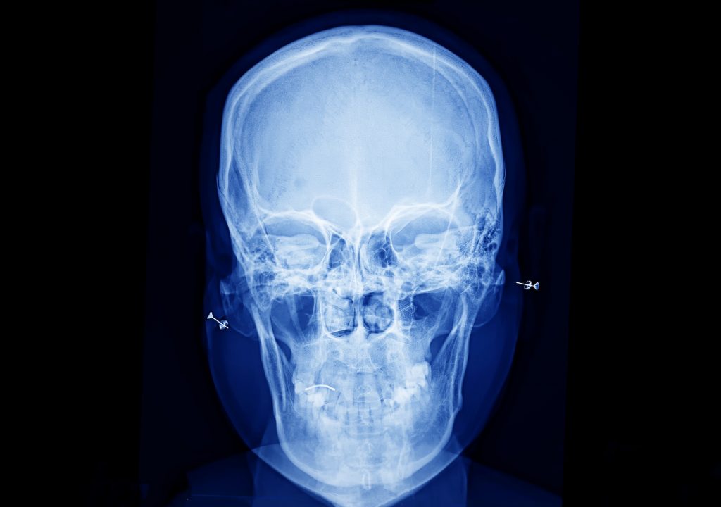 X-Ray film scan of human.