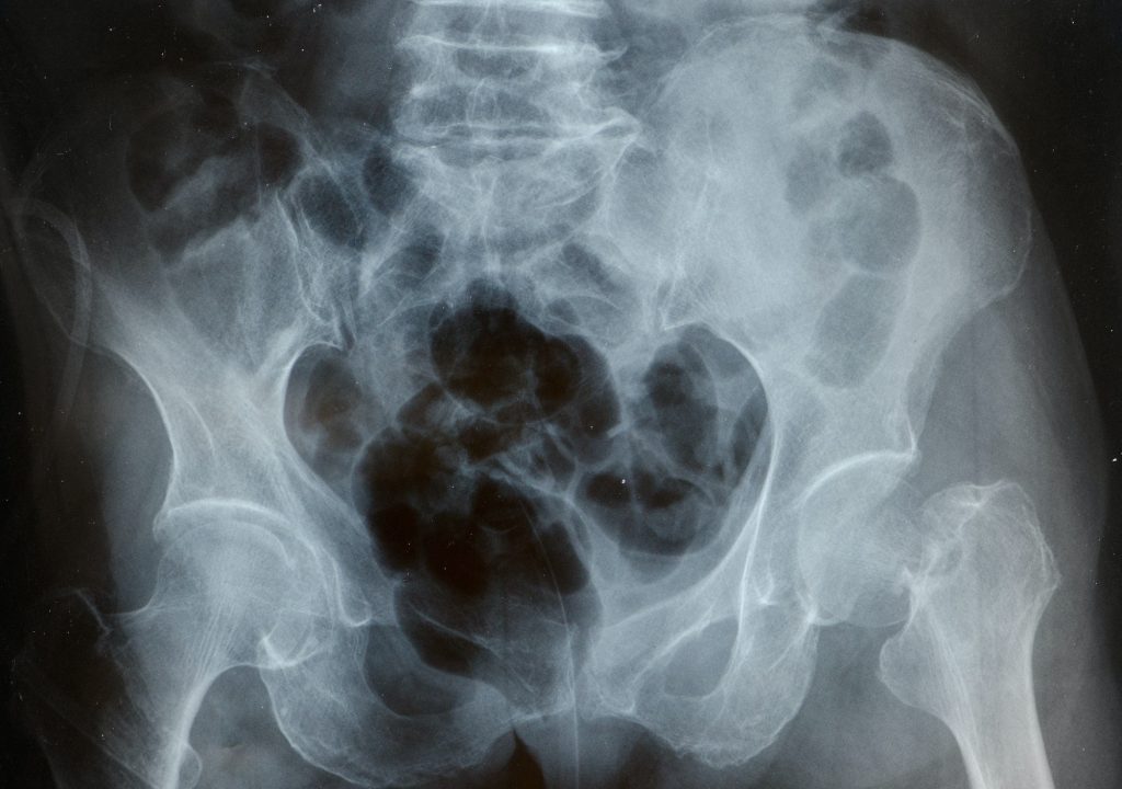 x-rays